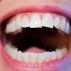 Perawatan Gigi dan Mulut pada Lansia