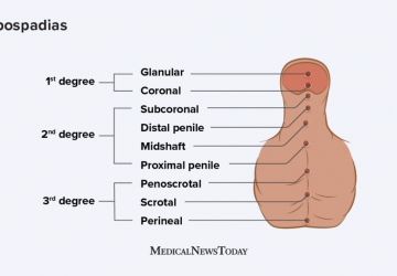 Hipospadia : Gejala, Penyebab dan Pengobatan